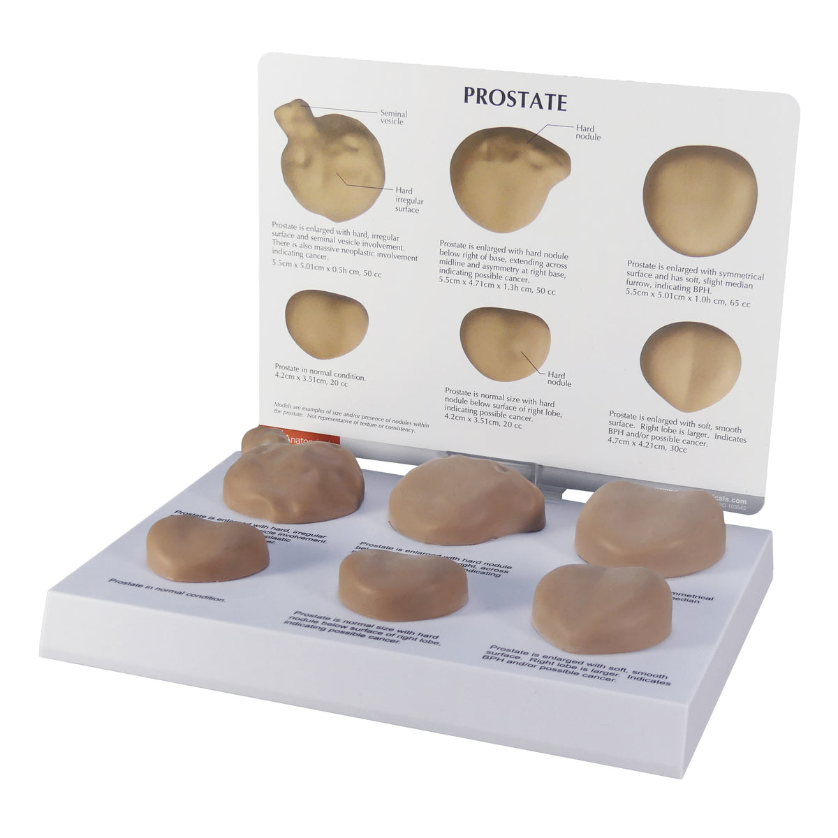 Prostate Scale Modle Prostate with Conditions Model Set – GPI 3D Anatomy
