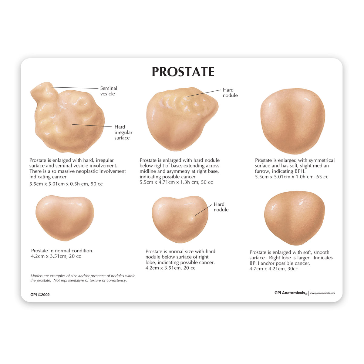Pattern 3 Prostate Prostate with Conditions Model Set – GPI 3D Anatomy