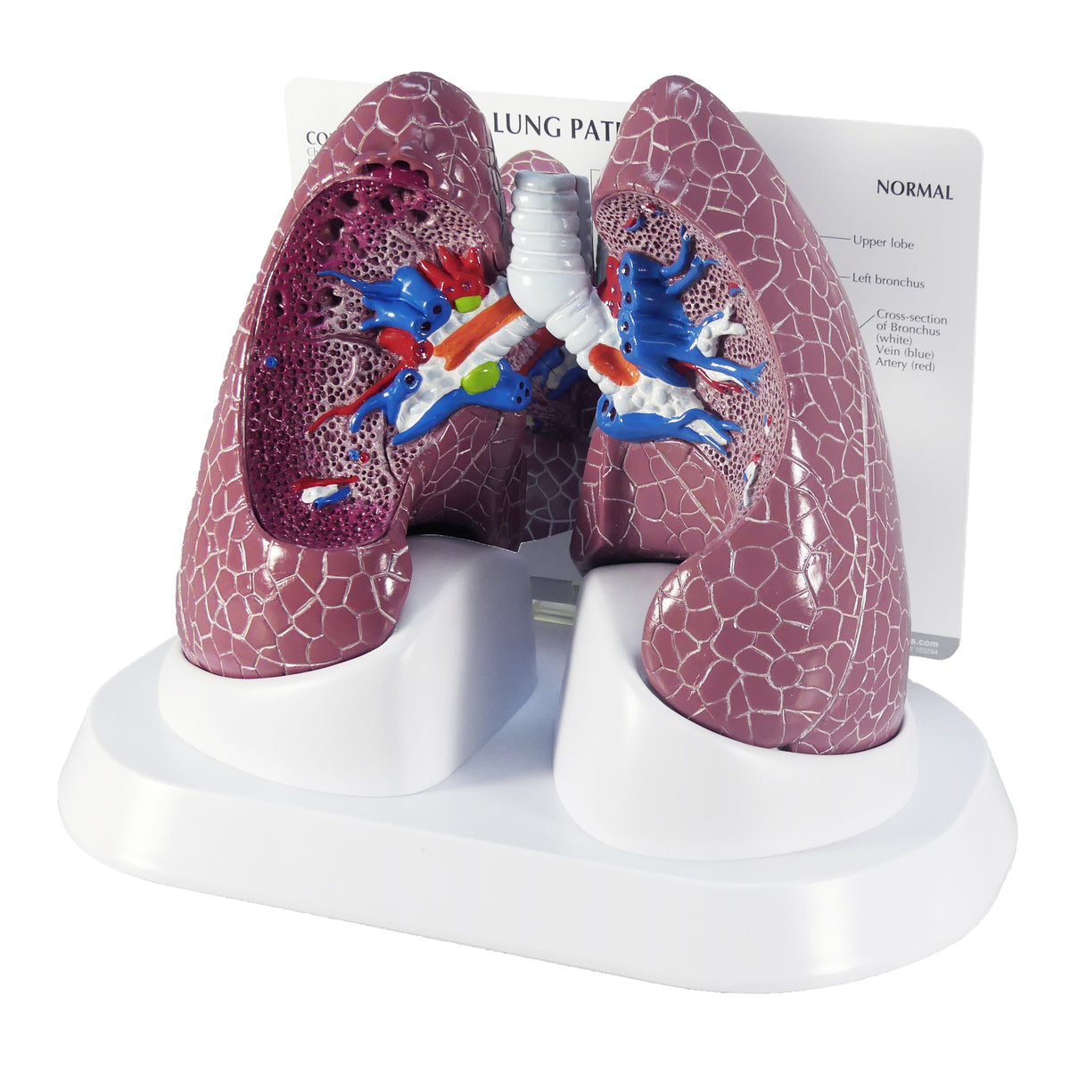 Basic Lung Model Lung Model Set with Pathologies – GPI 3D Anatomy