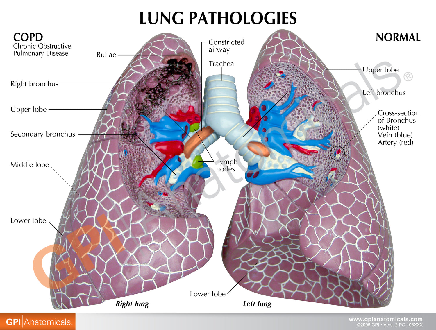 Lung Model Set with Pathologies – GPI 3D Anatomy