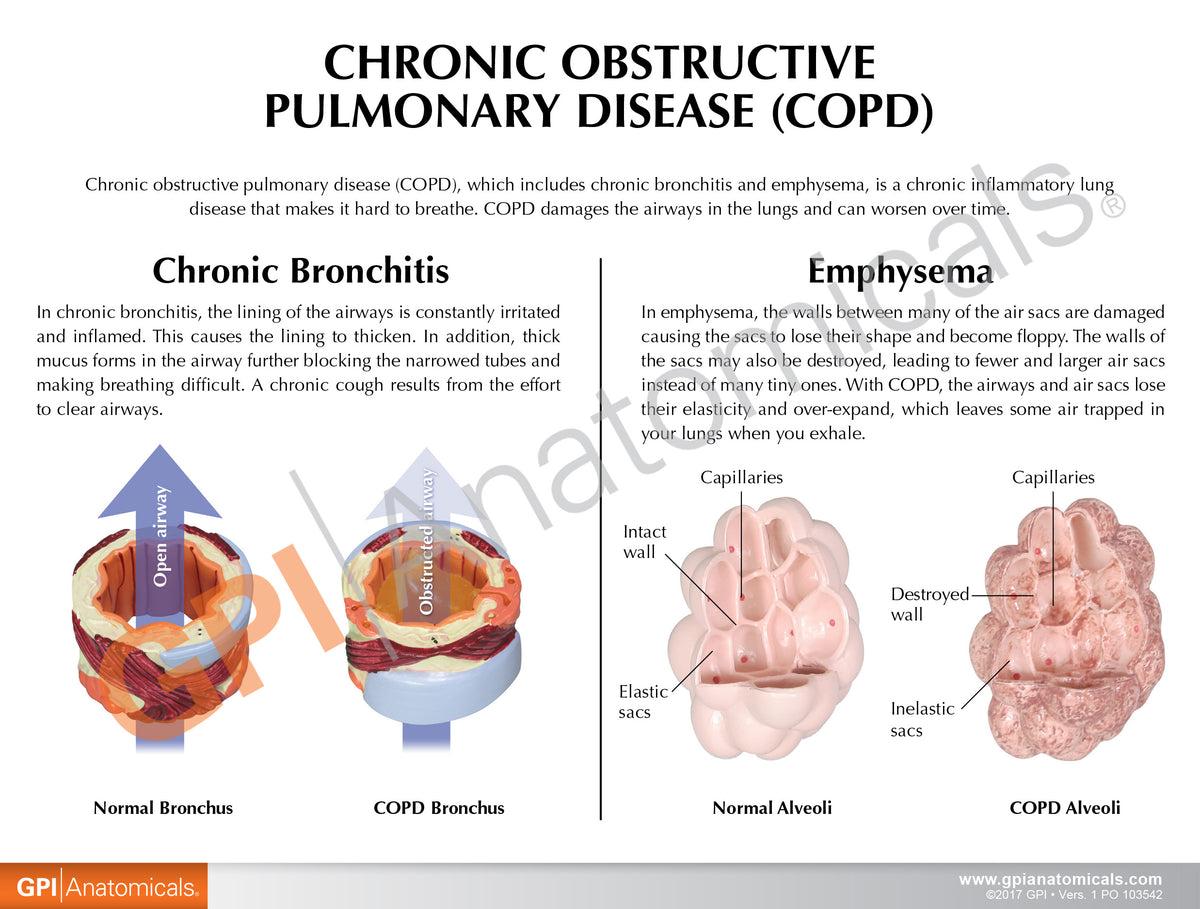 Copd Effects Respiratory System Model with Chronic Obstructive Pulmonary Disease (C ...