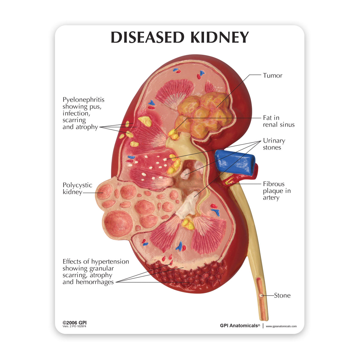 Normal and Diseased Kidney Model – GPI 3D Anatomy