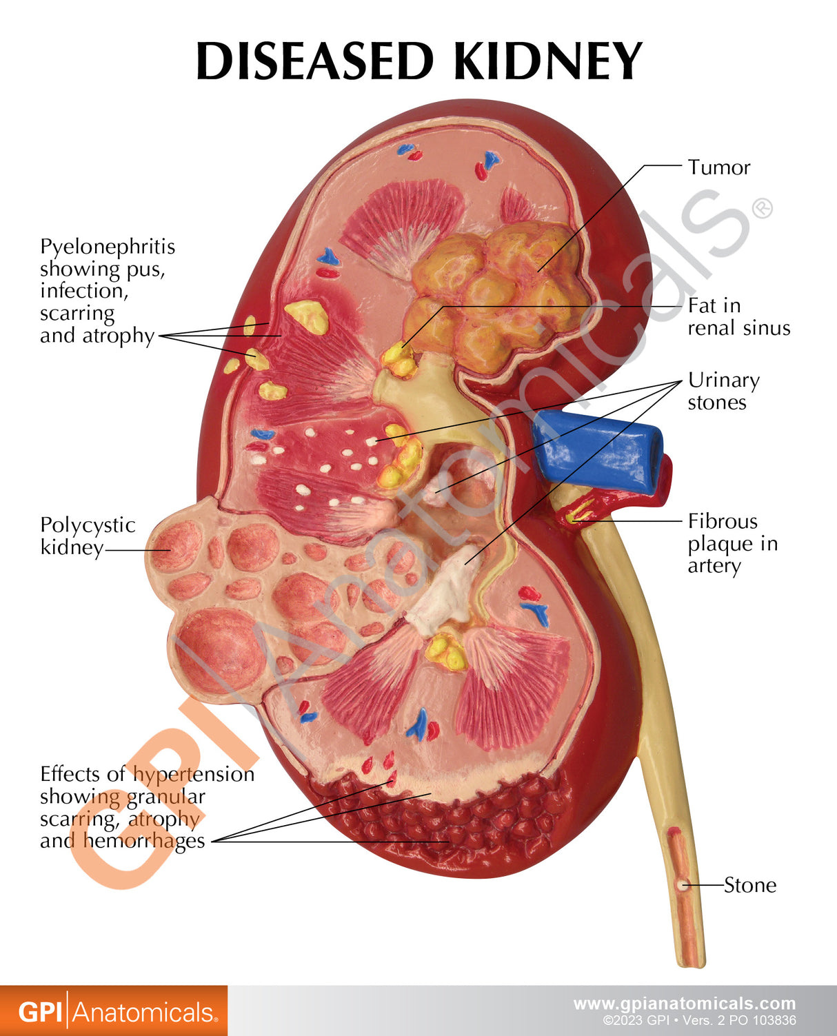 Normal and Diseased Kidney Model