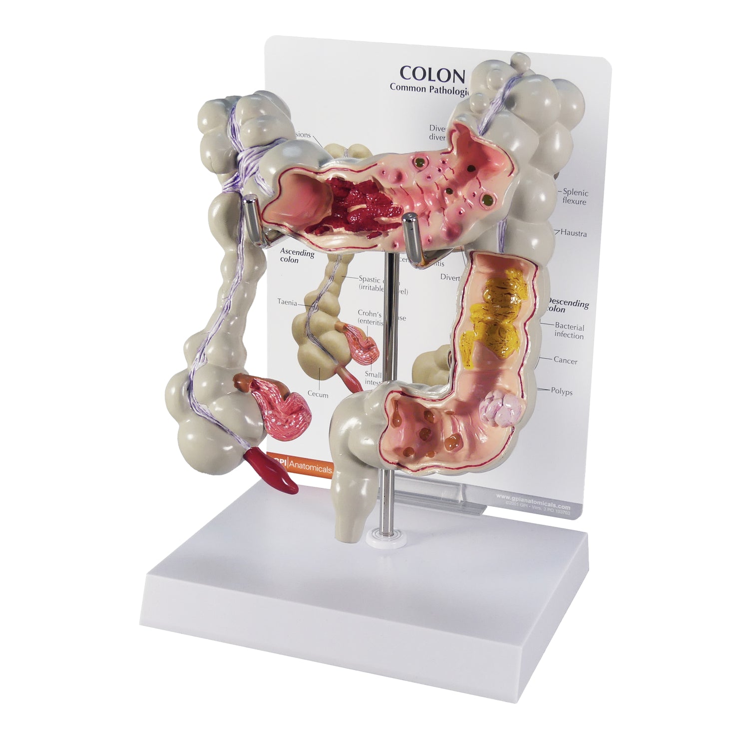 Colon Model with Common Pathologies – GPI 3D Anatomy