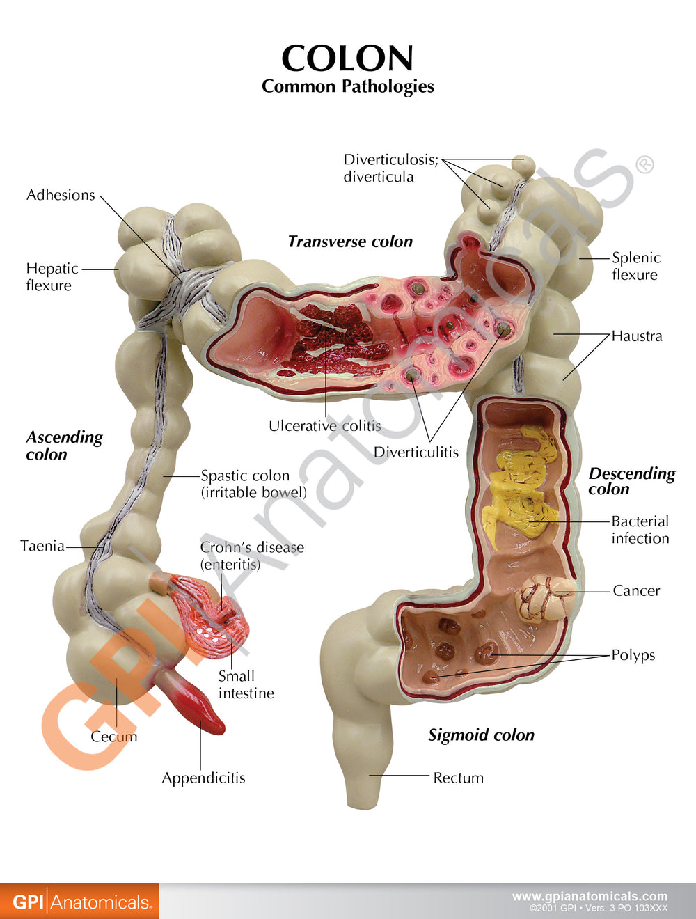 Colon Model with Common Pathologies – GPI 3D Anatomy