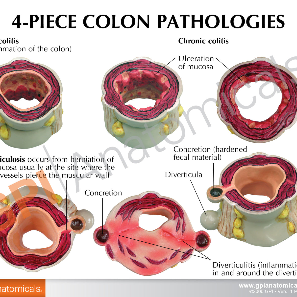 4-Piece Colon Set Education Card – GPI 3D Anatomy