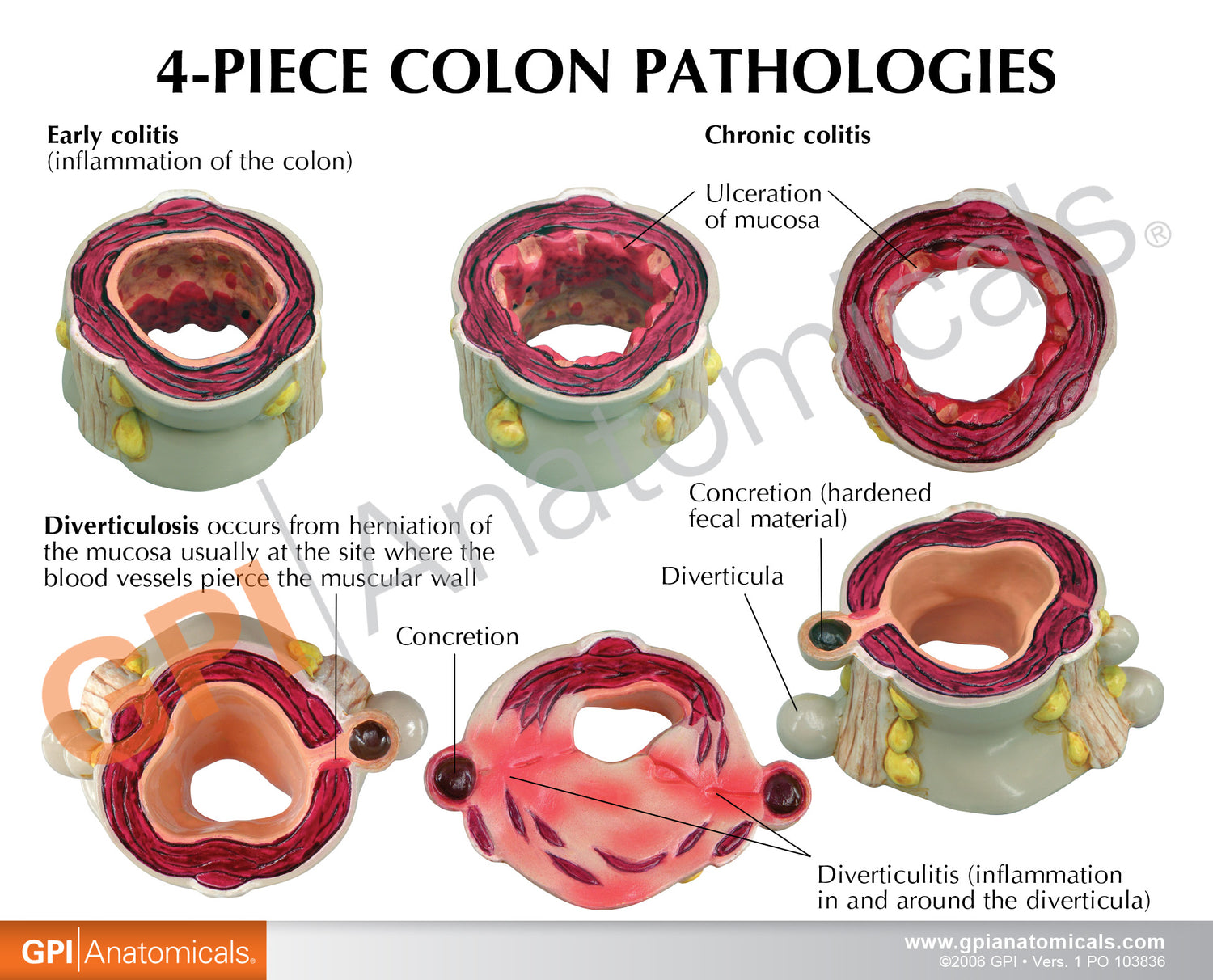 4-Piece Colon Model Set with Pathologies – GPI 3D Anatomy