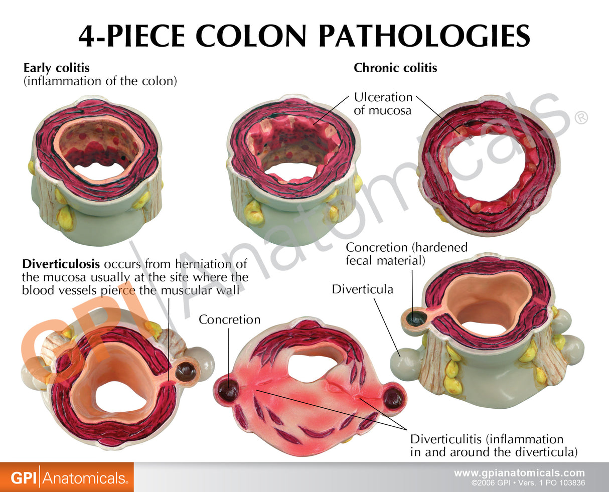 4-Piece Colon Model Set with Pathologies