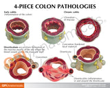 4-Piece Colon Model Set with Pathologies