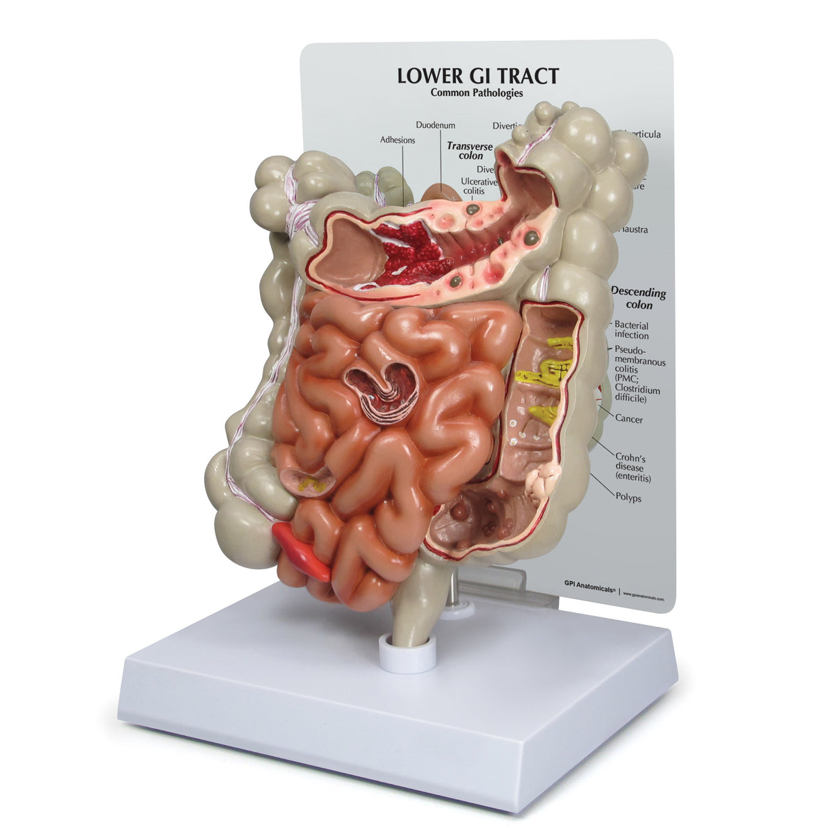 GI Tract Model with Common Pathologies – GPI 3D Anatomy