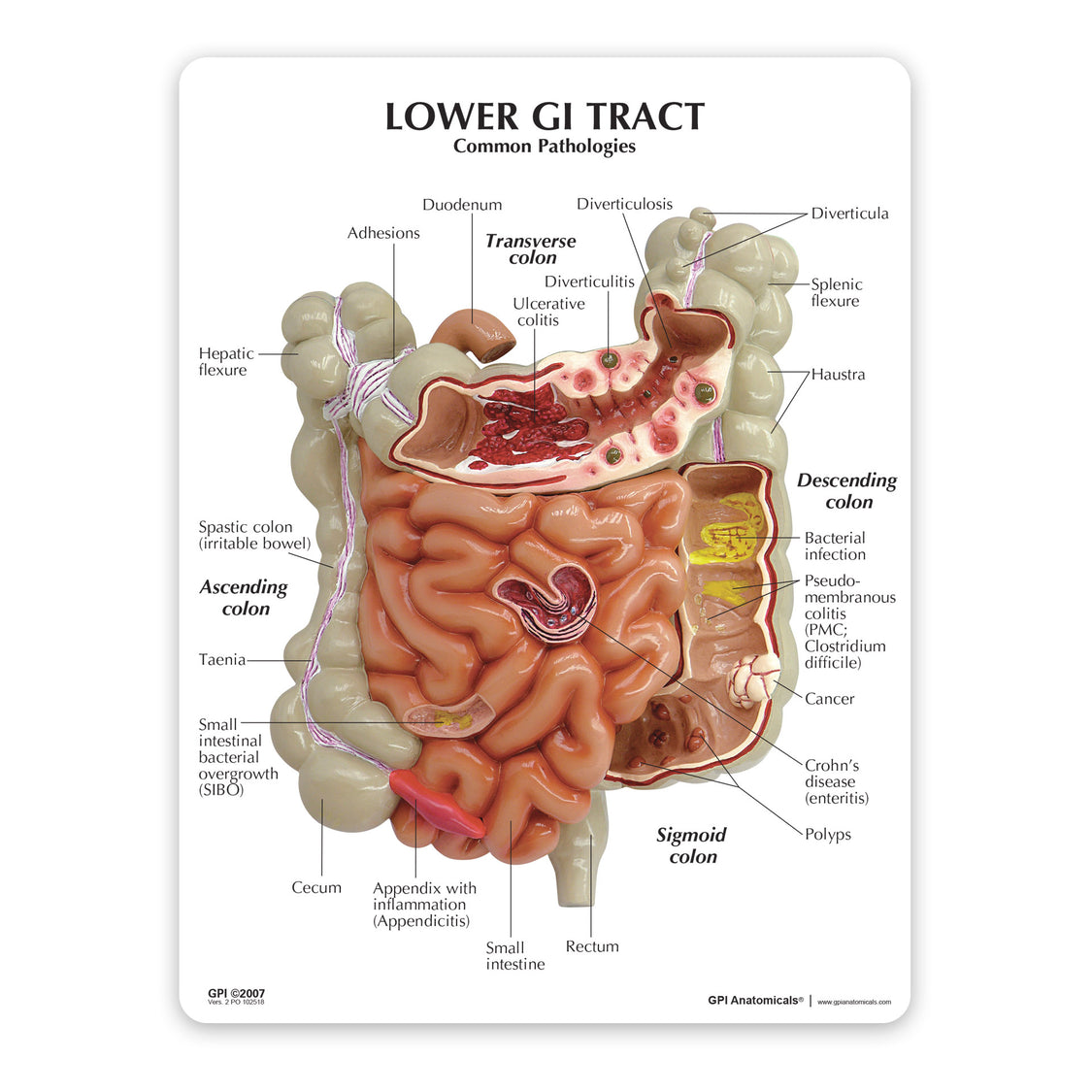 Defect Gi GI Tract Model with Common Pathologies – GPI 3D Anatomy