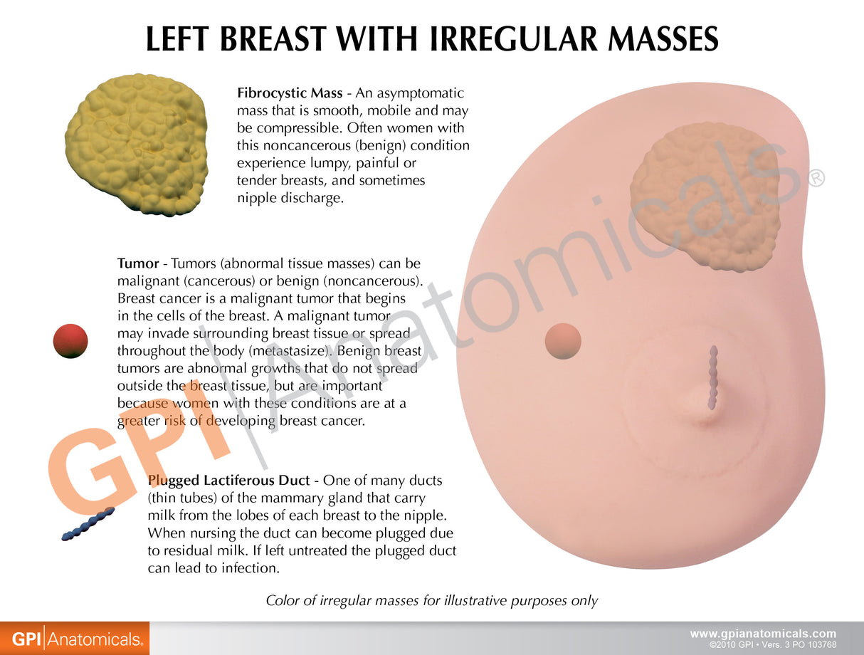 Left Breast Model with Irregular Masses