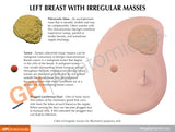 Left Breast Model with Irregular Masses
