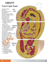 Obesity Model
