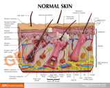 Skin Acne Cross-Section Model