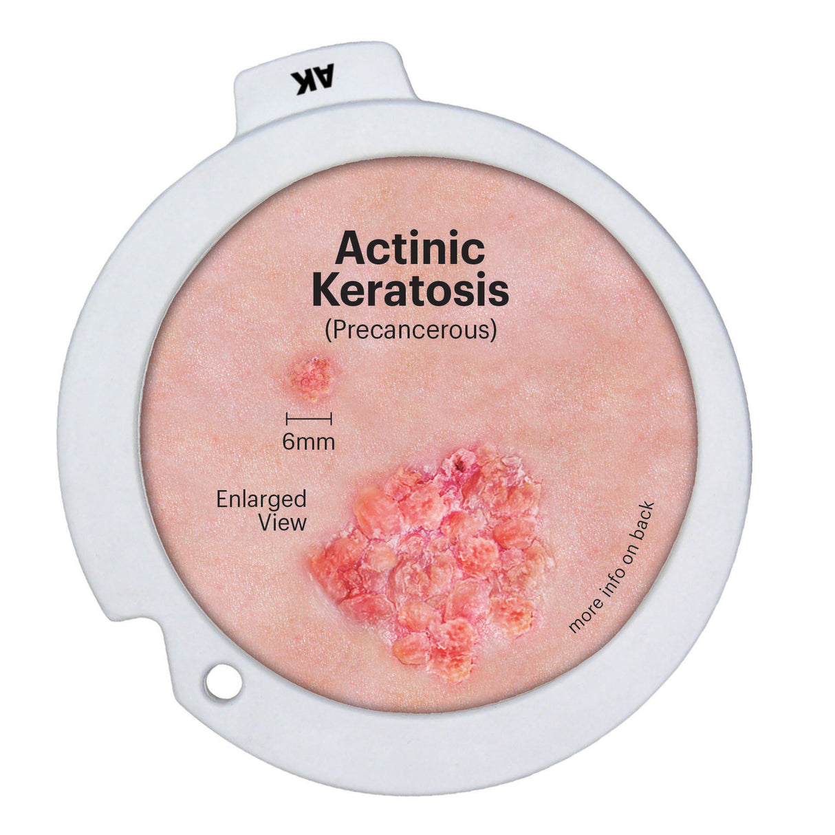 Skin Cancer Model