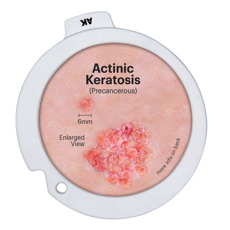 Skin Cancer Model