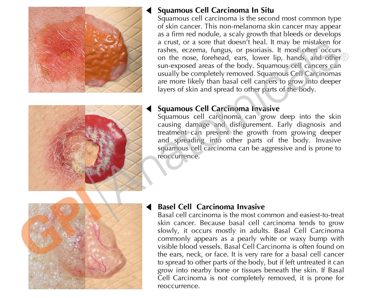 Melanoma Skin Cancer