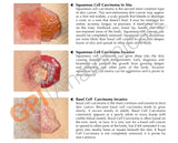 Melanoma Skin Cancer