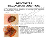 Melanoma Skin Cancer