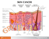 Melanoma Skin Cancer