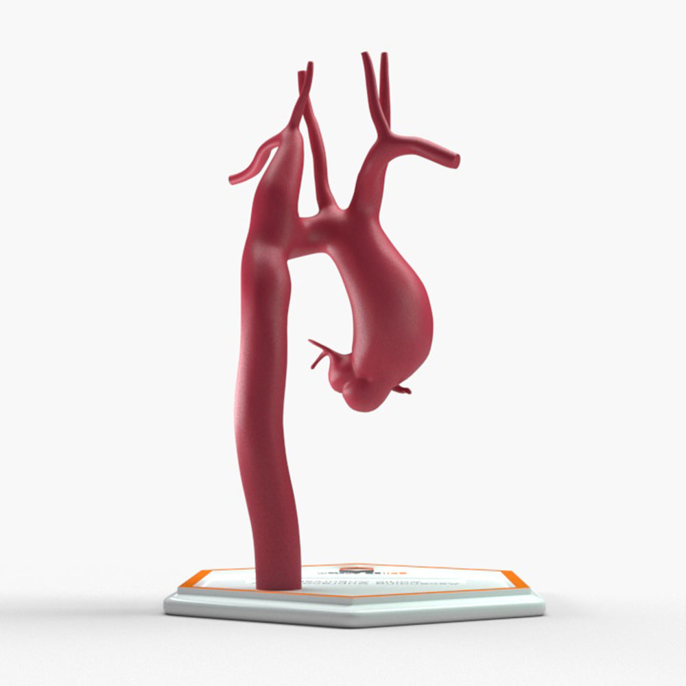 Ascending Supracoronary Aortic Aneurysm