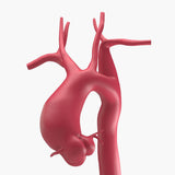 Ascending Supracoronary Aortic Aneurysm