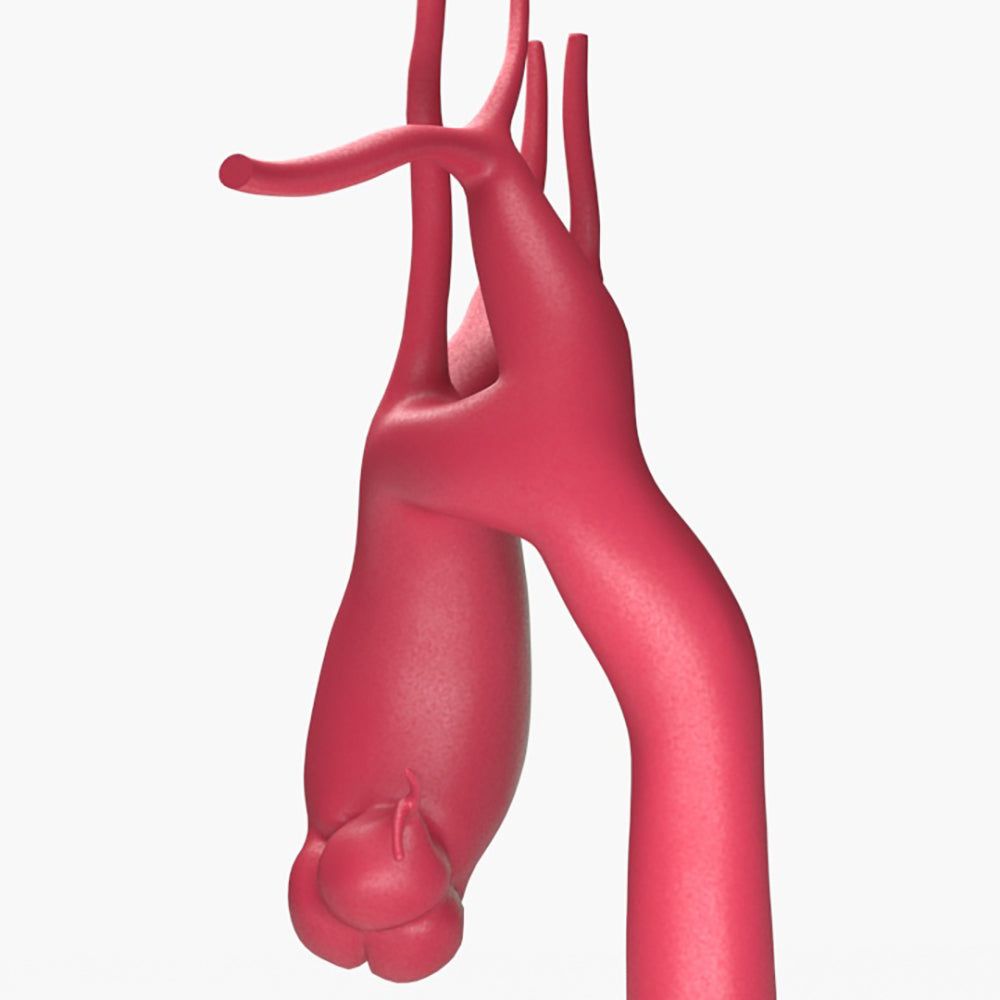 Ascending Supracoronary Aortic Aneurysm