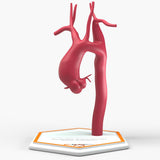 Ascending Supracoronary Aortic Aneurysm