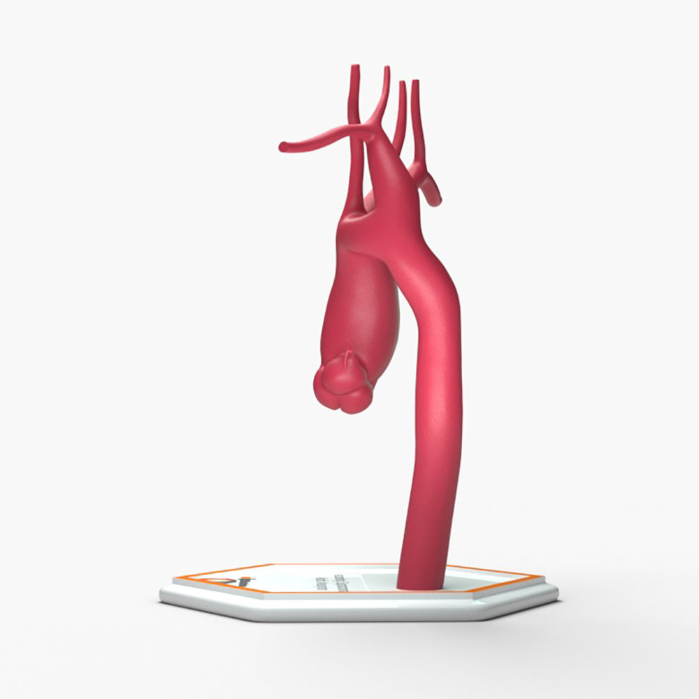 Ascending Supracoronary Aortic Aneurysm