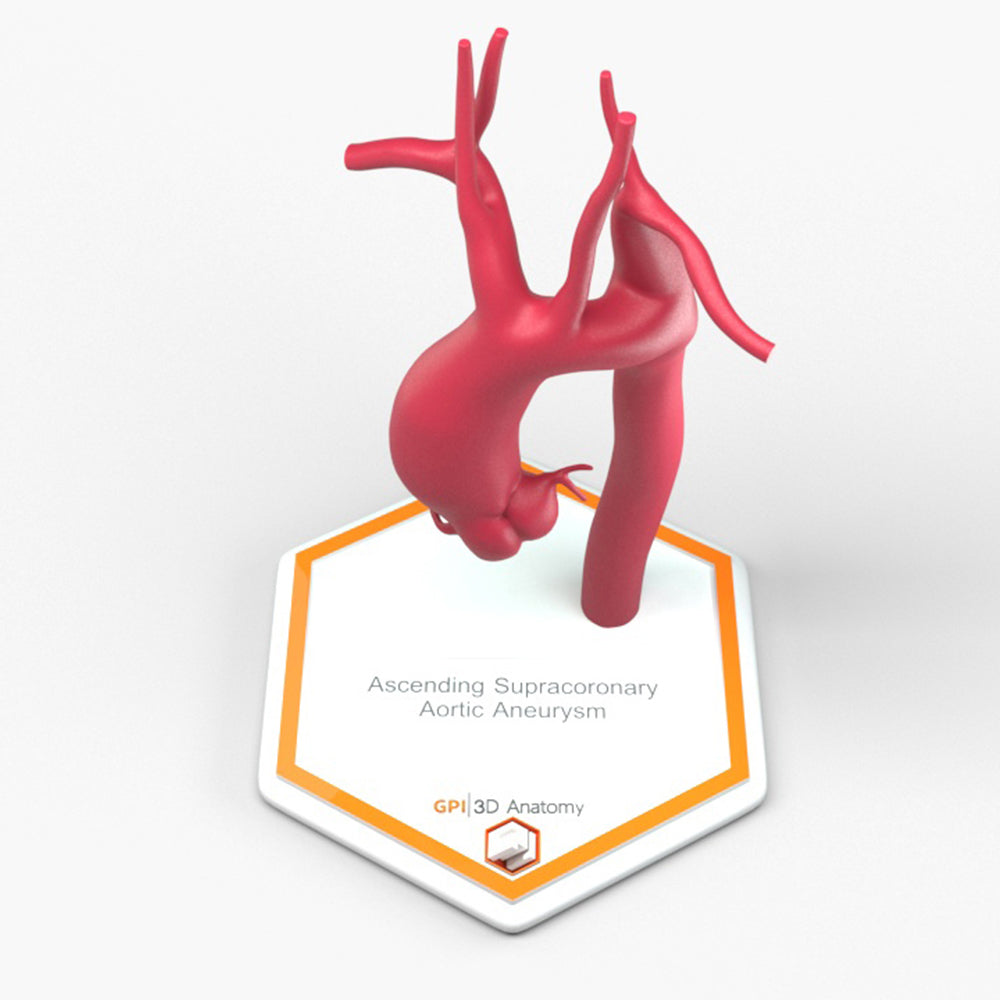 Ascending Supracoronary Aortic Aneurysm