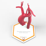 Ascending Supracoronary Aortic Aneurysm