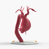Supracoronary Ascending Aortic Aneurysm