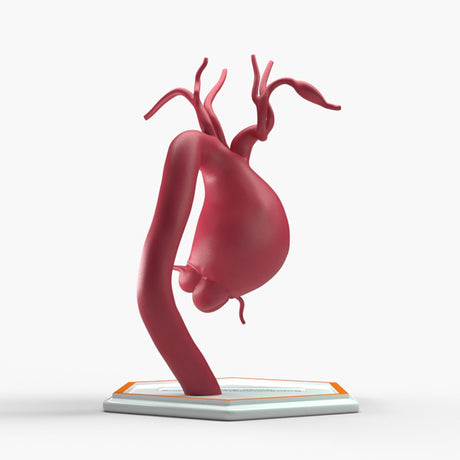 Supracoronary Ascending Aortic Aneurysm