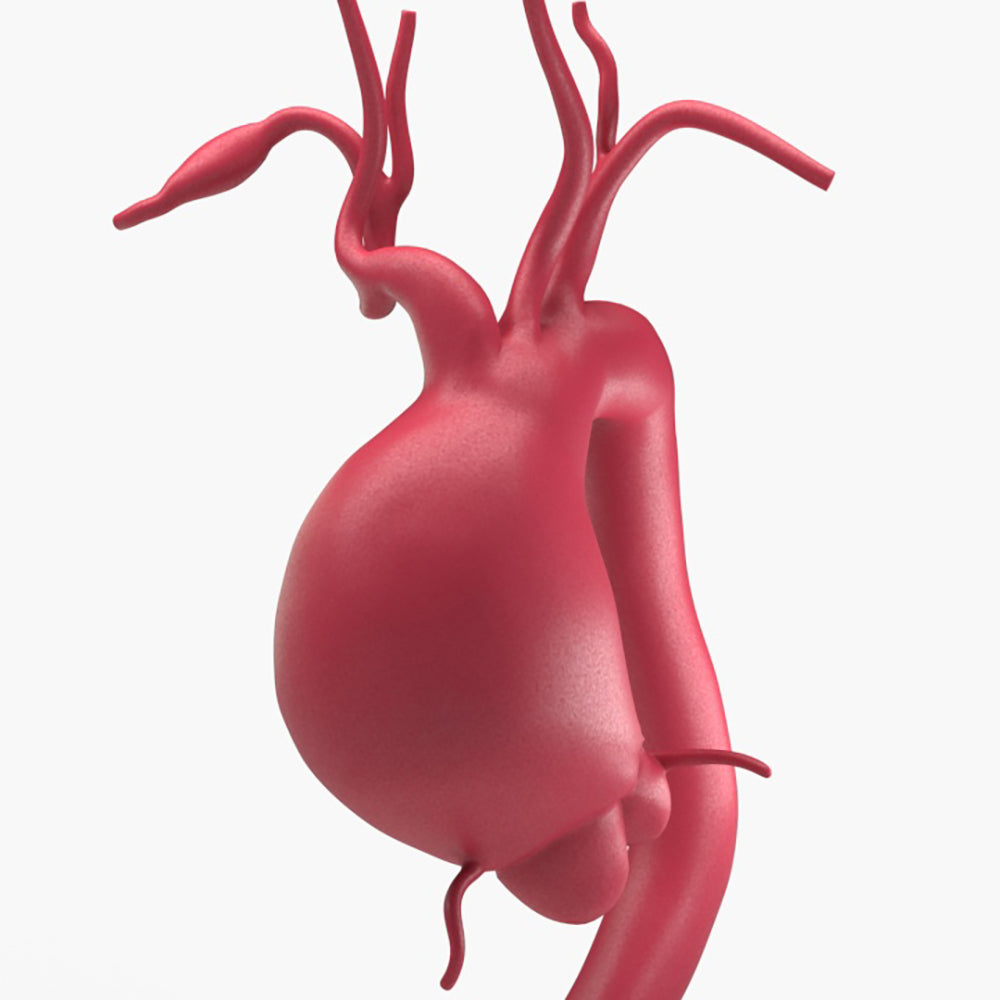 Supracoronary Ascending Aortic Aneurysm