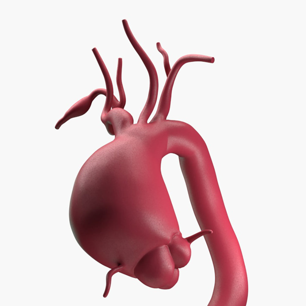 Supracoronary Ascending Aortic Aneurysm