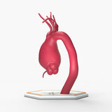 Supracoronary Ascending Aortic Aneurysm