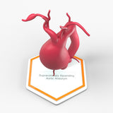 Supracoronary Ascending Aortic Aneurysm