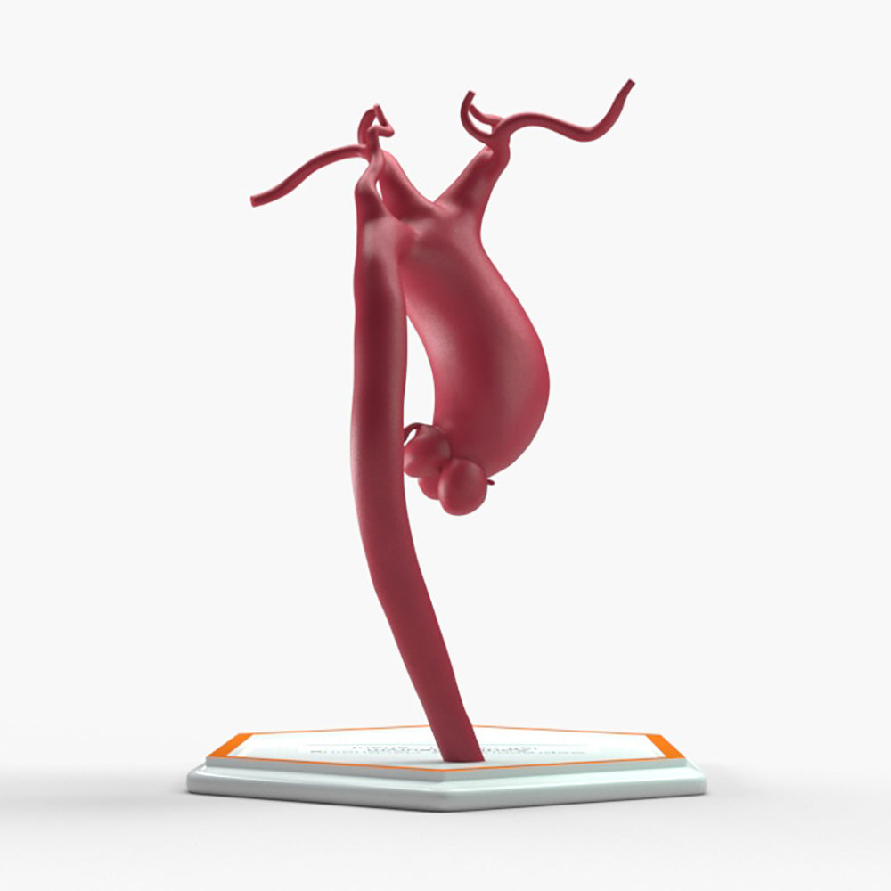 Supracoronary Ascending Aortic Aneurysm Left Carotid Variant