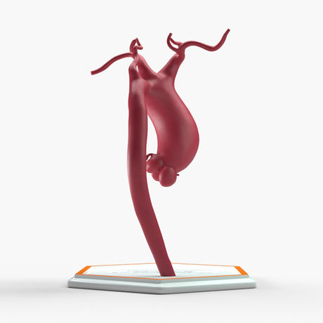 Supracoronary Ascending Aortic Aneurysm Left Carotid Variant
