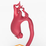 Supracoronary Ascending Aortic Aneurysm Left Carotid Variant