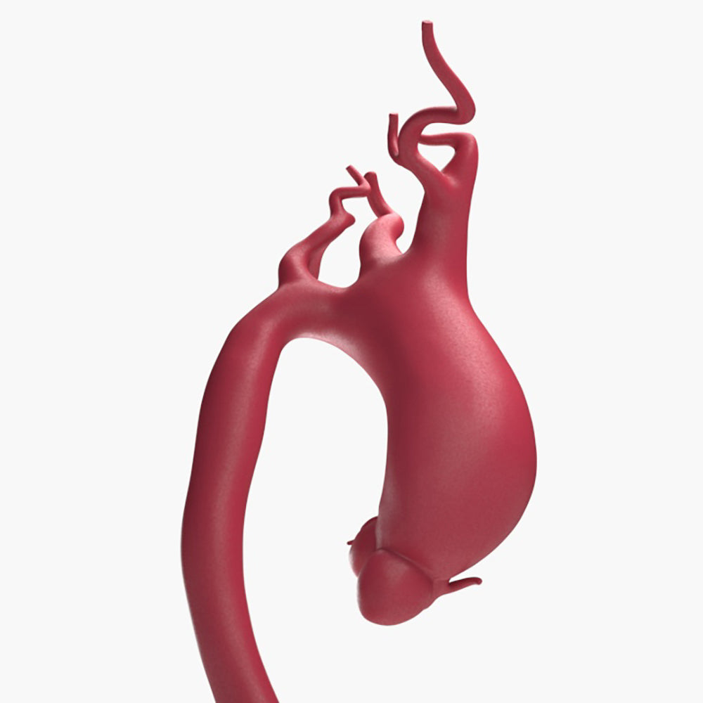 Supracoronary Ascending Aortic Aneurysm Left Carotid Variant