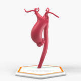 Supracoronary Ascending Aortic Aneurysm Left Carotid Variant