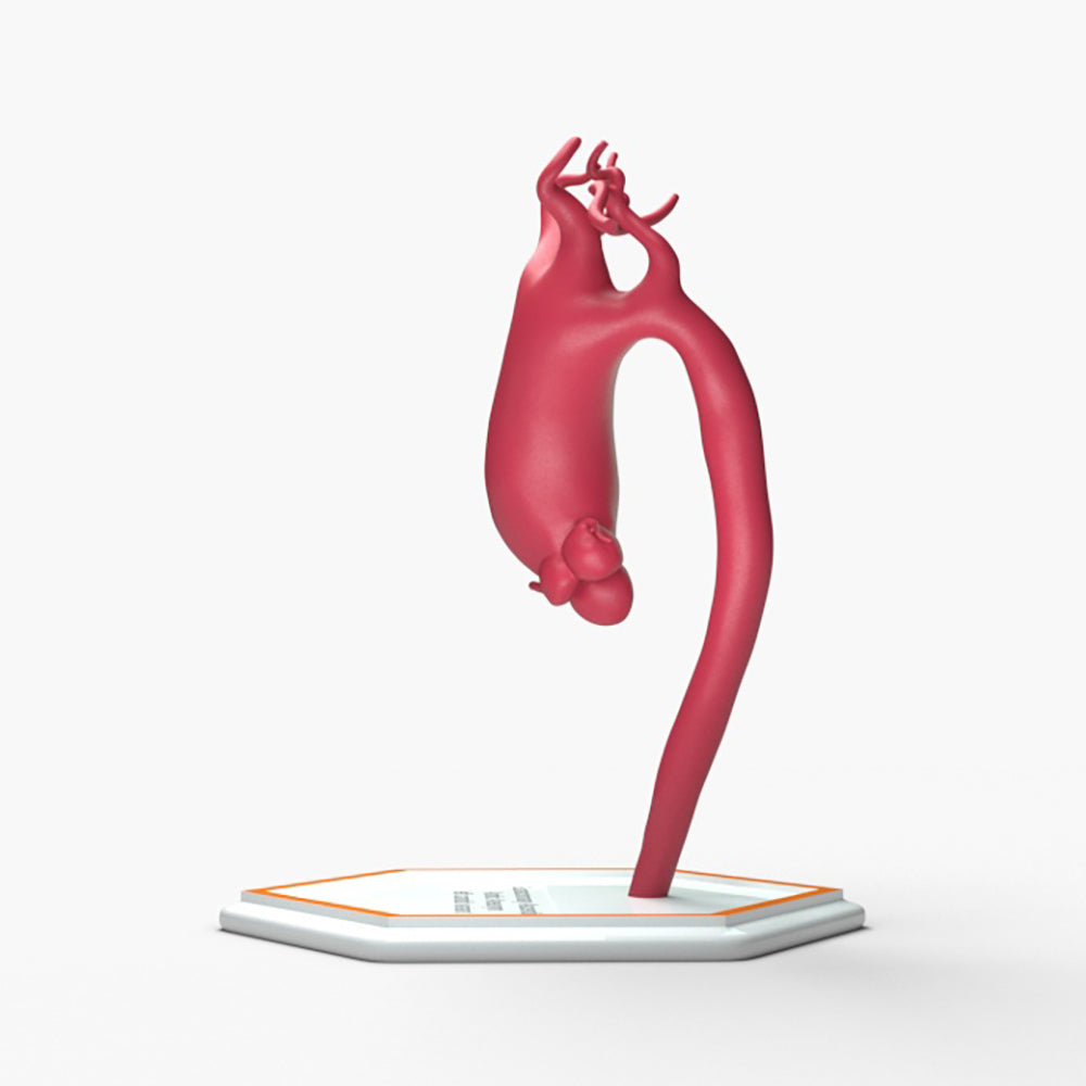 Supracoronary Ascending Aortic Aneurysm Left Carotid Variant