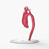 Supracoronary Ascending Aortic Aneurysm Left Carotid Variant