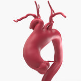 Ascending Supracoronary Aortic Arch and Innominate Artery Aneurysm