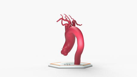 Ascending Supracoronary Aortic Arch and Innominate Artery Aneurysm