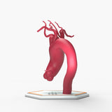 Ascending Supracoronary Aortic Arch and Innominate Artery Aneurysm