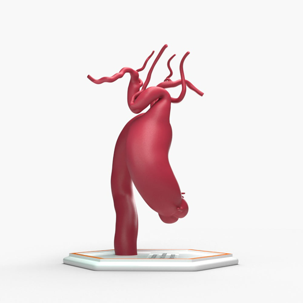 Ascending Supracoronary Aortic Arch and Innominate Artery Aneurysm