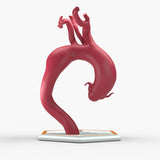 Fusiform Ascending & Descending Aortic Aneurysm 2